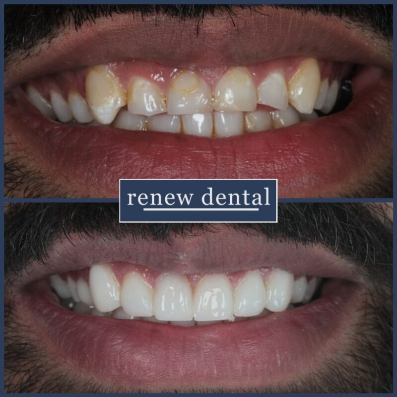 Composite Bonding Walsall Wolverhampton Renew Dental
